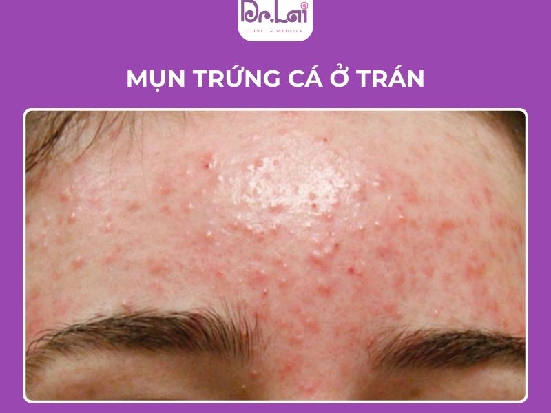 Thay đổi nội tiết làm tăng tiết dầu