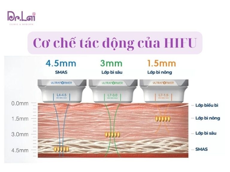 Công nghệ HIFU