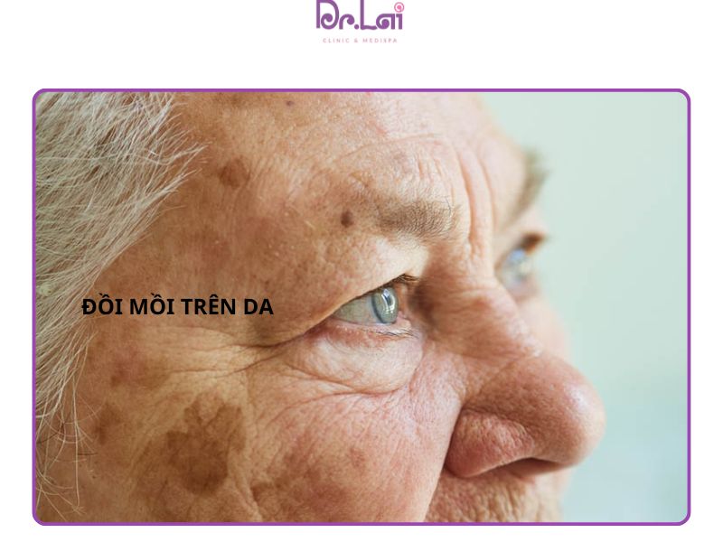 Đồi mồi trên mặt