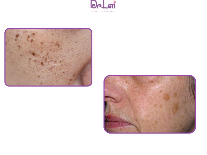 Sự hình thành đồi mồi có liên quan đến quá trình tích tụ melanin trong thời gian dài