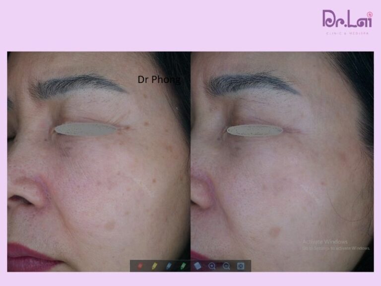 HÌnh ảnh thực tế trẻ hóa da tại Dr.Lai