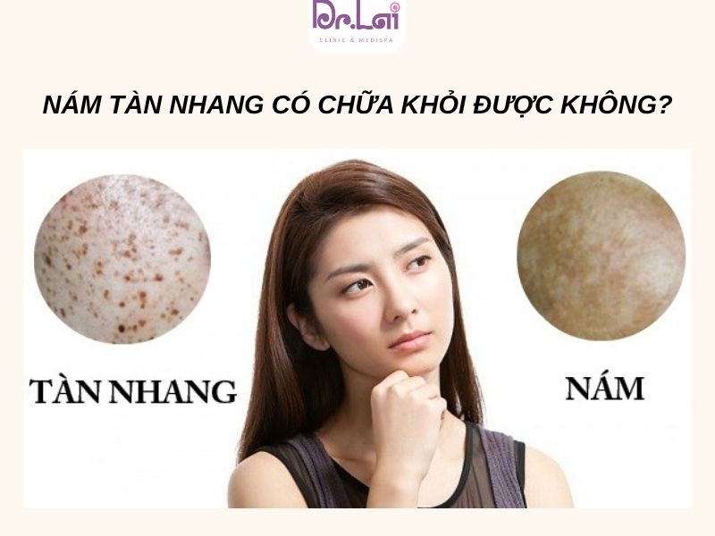 Nám và tàn nhang