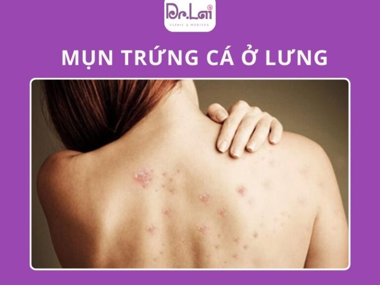 Mụn trứng cá ở lưng