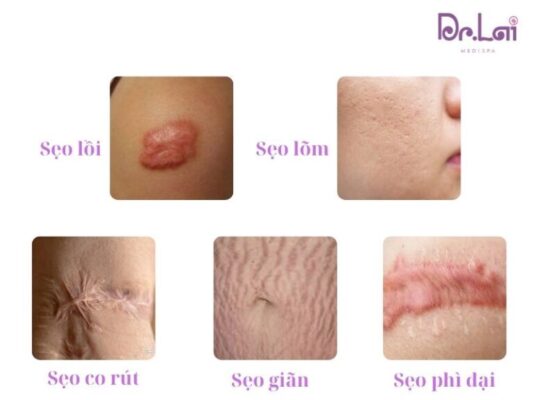Cắt đáy sẹo