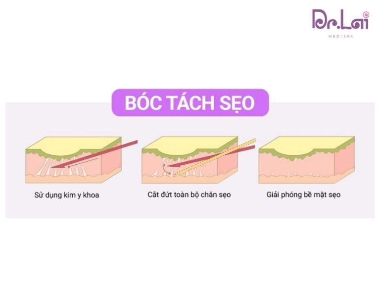 Cắt đáy sẹo kết hợp PRP