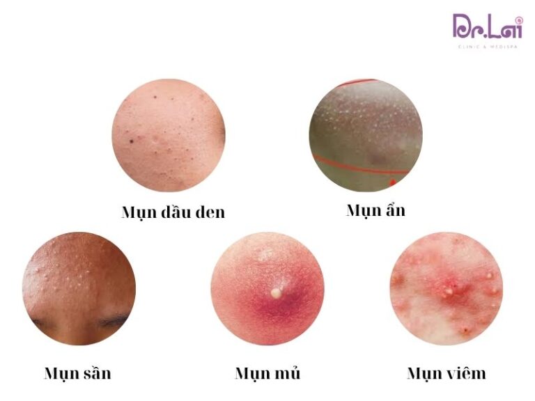 Vì sao nên cân nhắc kỹ khi lựa chọn nơi điều trị mụn?