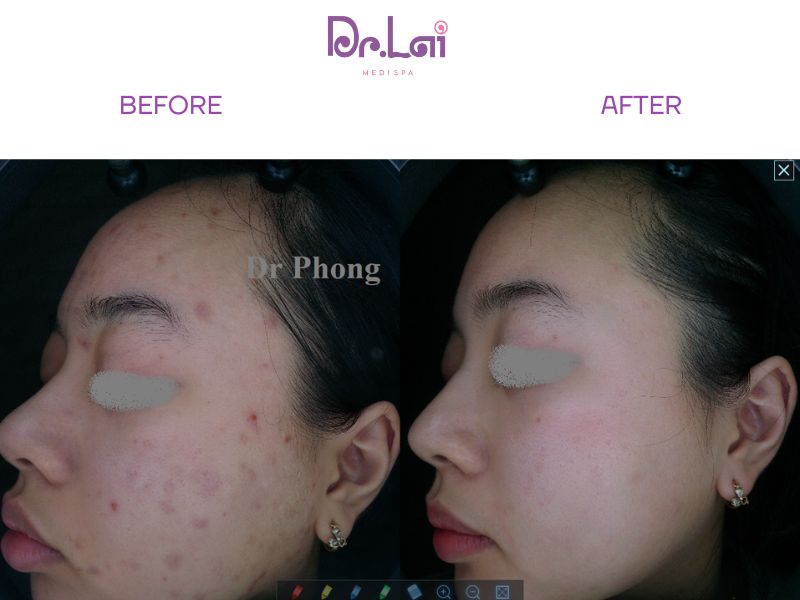 thâm mụn có thể kéo dài