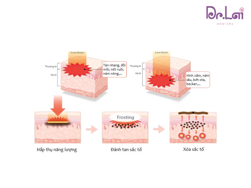 Trị thâm mụn bằng công nghê Laser YAG
