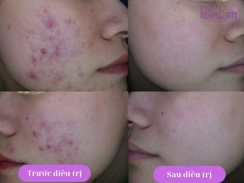 IPL có thể được ứng dụng cho da thâm mụn
