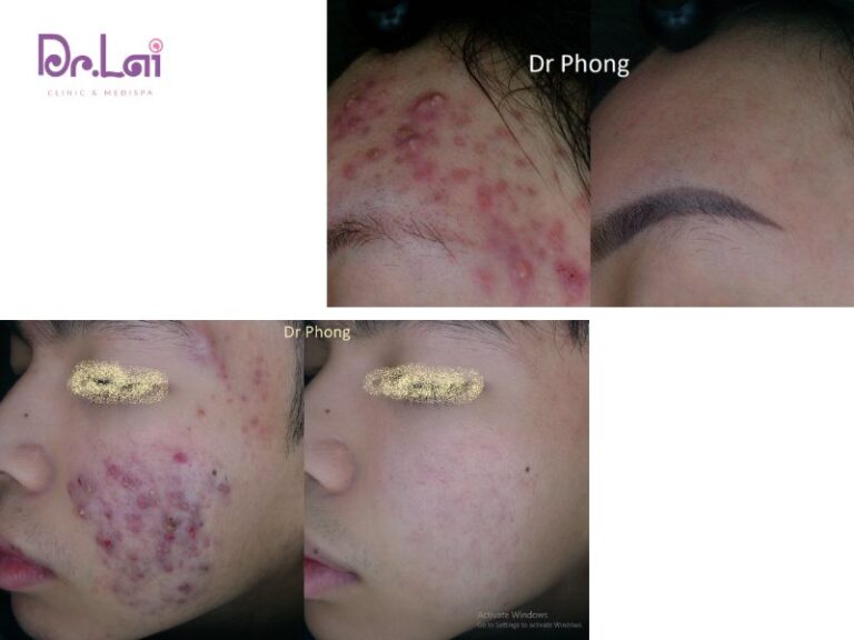 Lấy nhân mụn chuẩn y khoa
