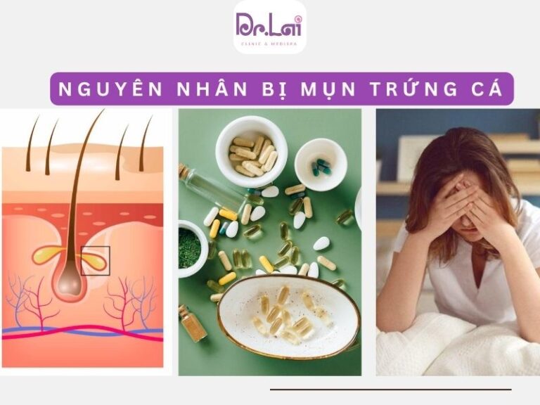 Bản chất sinh lý của mụn trứng cá trên da
