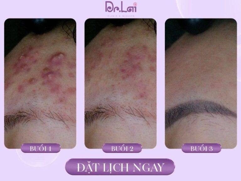 Các yếu tố ảnh hưởng trực tiếp đến chi phí chữa mụn