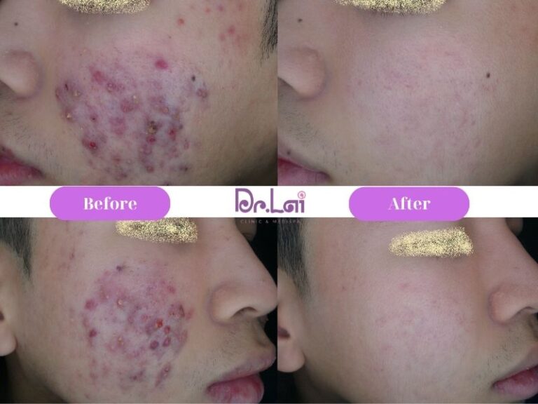 Bảng giá điều trị mụn tham khảo cho từng liệu trình