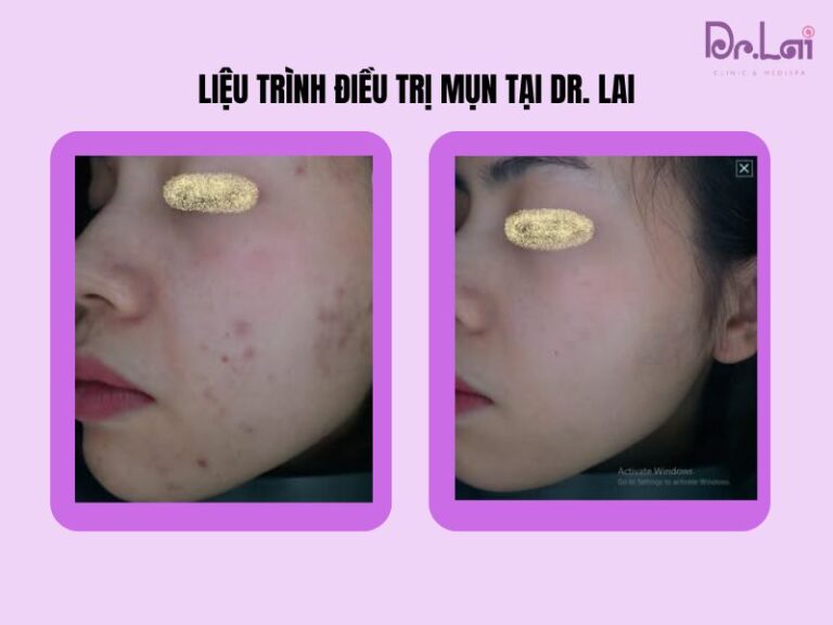 Các phương pháp y khoa xóa thâm mụn hiệu quả hiện nay